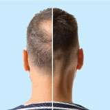 Male Pattern Baldness Treatment Result