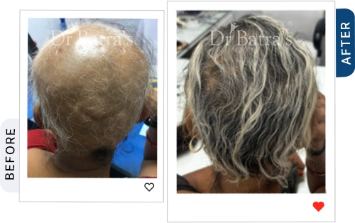 01 Alopecia Before After