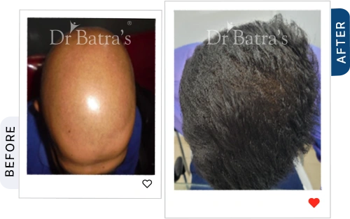 02 Alopecia Before After