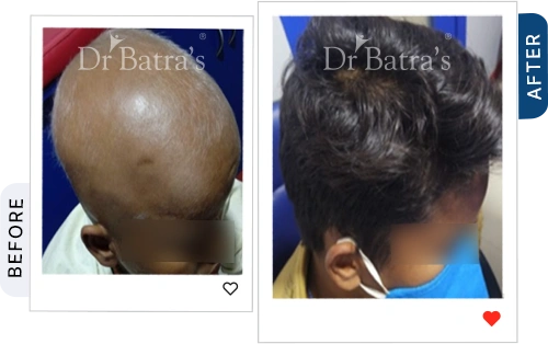 03 Alopecia Before After