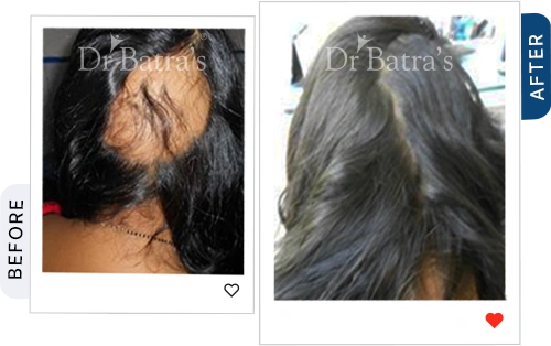 04 Alopecia Before After