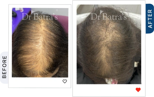 05 Alopecia Before After