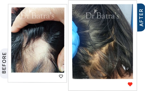 06 Alopecia Before After