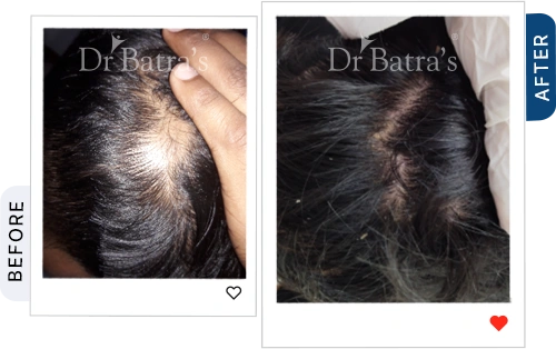 07 Alopecia Before After
