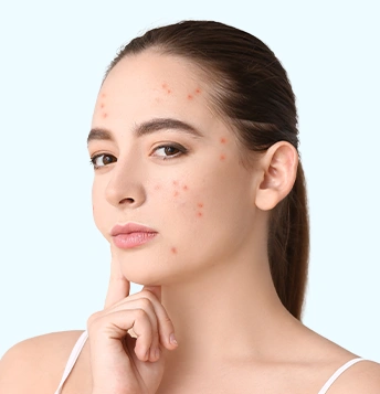 Acne Model