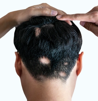 hairloss Model