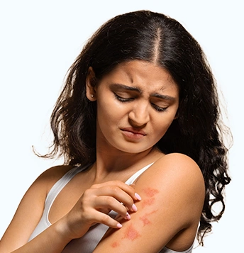Psoriasis Model