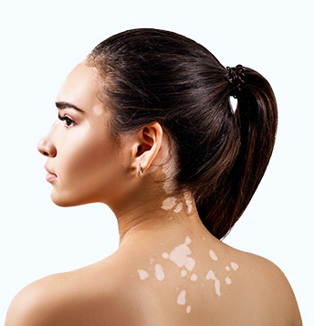 Vitiligo Model