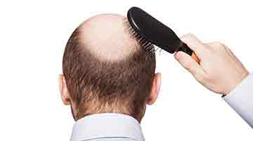 male pattern baldness