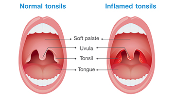 tonsillitis