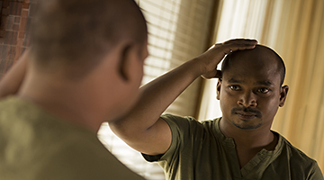 male pattern baldness