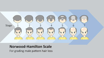 male pattern baldness