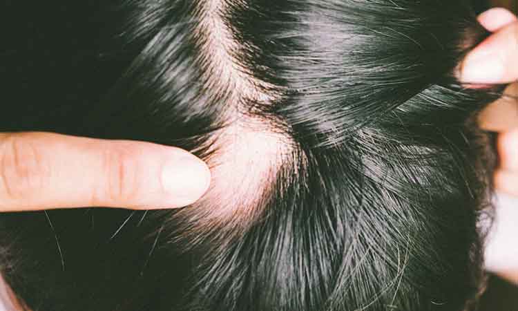 5 Common Types Of Hair Loss Dr Batra S