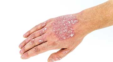 psoriasis