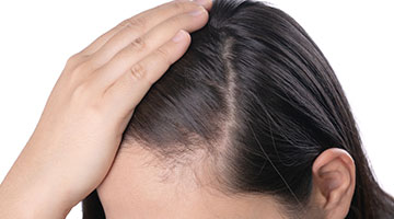 female pattern baldness