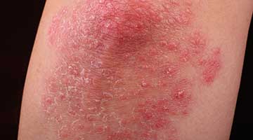 psoriasis