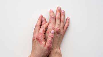 psoriasis