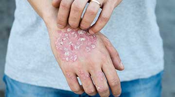 psoriasis