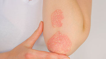 psoriasis