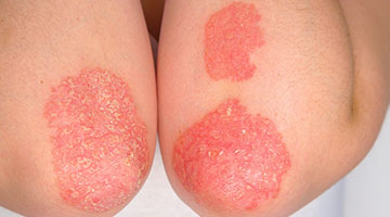 psoriasis