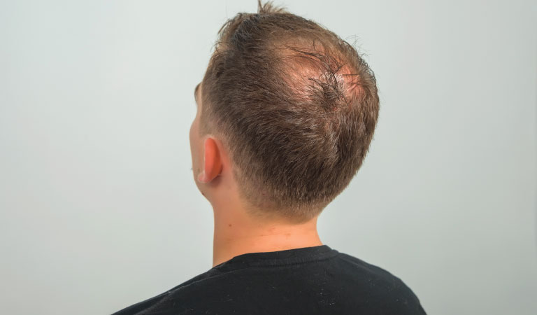 male pattern baldness