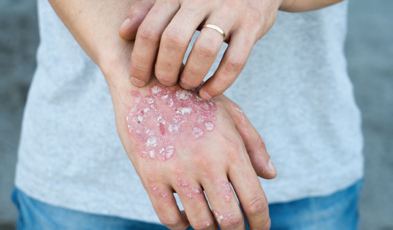 psoriasis