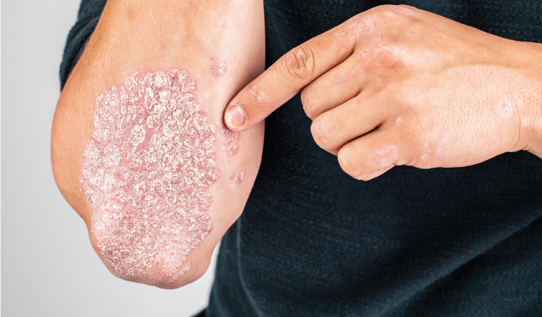 psoriasis