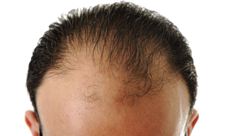 male pattern baldness