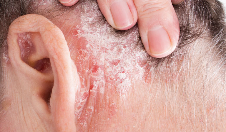 psoriasis