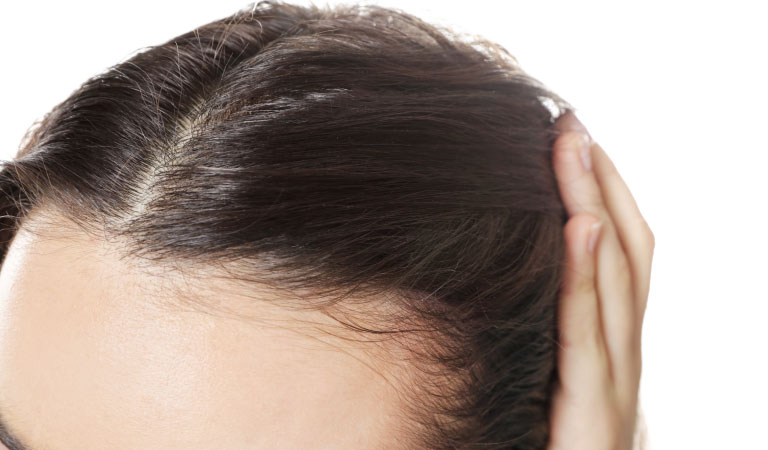 female pattern baldness