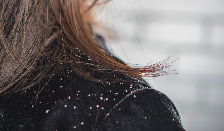 dandruff