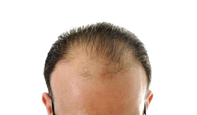 male pattern baldness