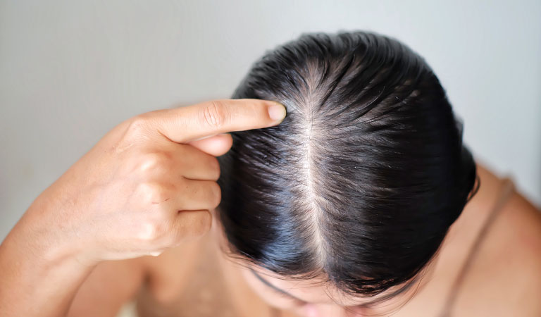 female pattern baldness