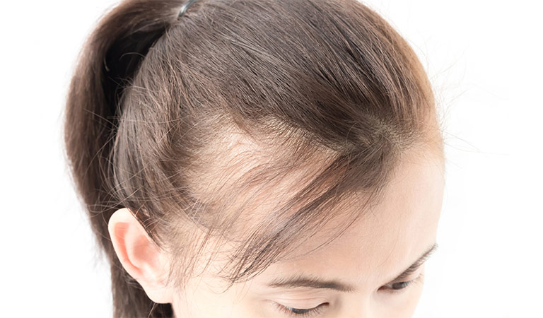 female pattern baldness