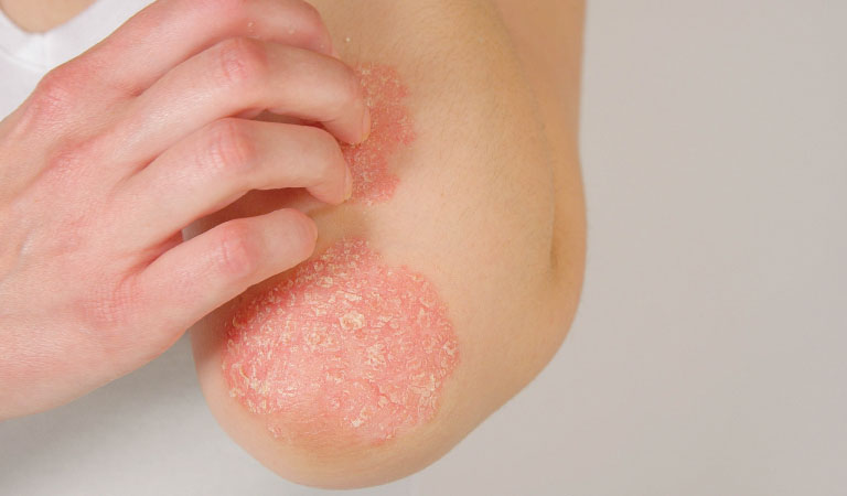 psoriasis