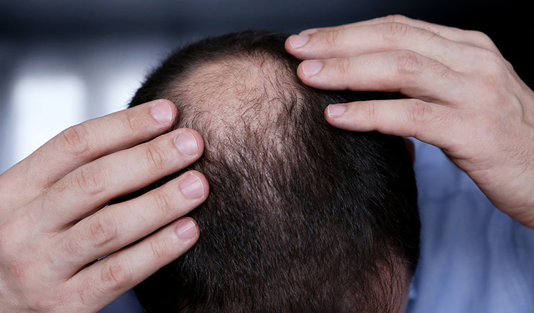 male pattern baldness