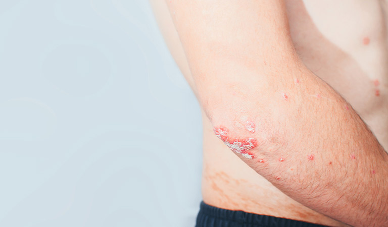 psoriasis