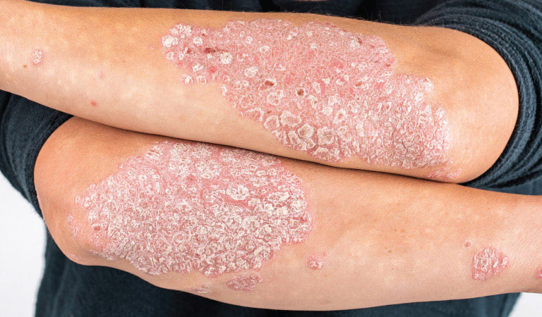 psoriasis