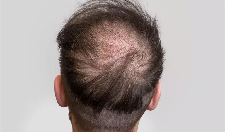 male pattern baldness