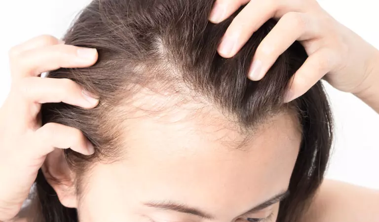 female pattern baldness