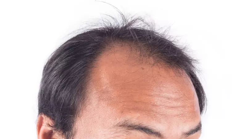 male pattern baldness