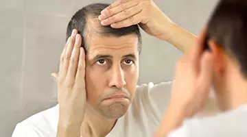 male pattern baldness