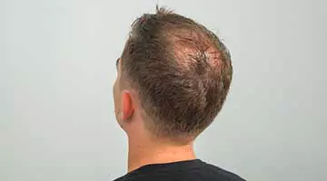 male pattern baldness