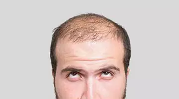 male pattern baldness