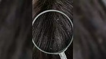 hair fall