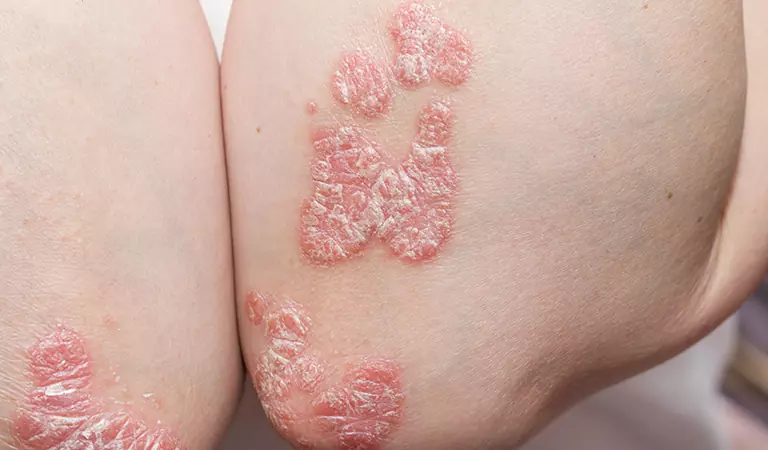 psoriasis