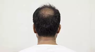 male pattern baldness