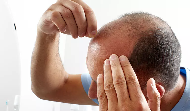 male pattern baldness