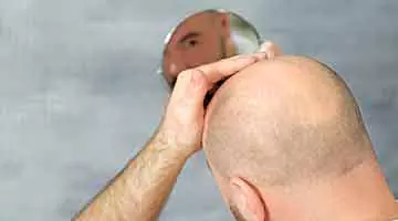 female pattern baldness