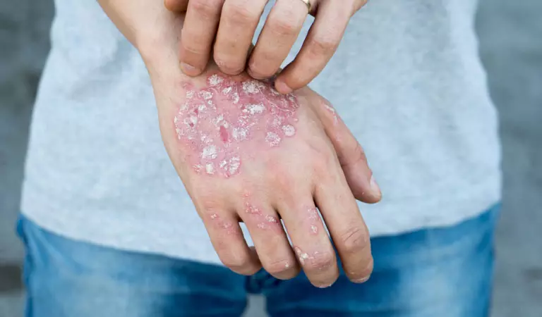 psoriasis